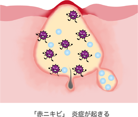 「赤ニキビ」炎症が起きる