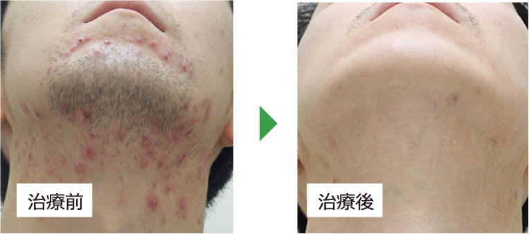 重症ニキビ ニキビ跡皮膚科 メディアージュ ニキビクリニック 重症ニキビ ニキビ跡皮膚科 メディアージュ ニキビクリニック
