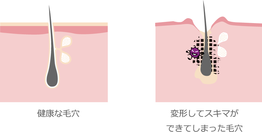 健康な毛穴変形してスキマができてしまった毛穴