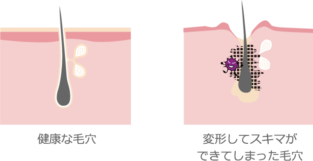 健康な毛穴変形してスキマができてしまった毛穴