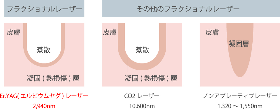 フラクショナルレーザー 皮膚 蒸散 凝固(熱損傷)層 Er.YAG(エルビウムヤグ)レーザー2,940nm その他のフラクショナルレーザー 皮膚 蒸散 凝固(熱損傷)層 CO2レーザー 10,600nm 皮膚 凝固層 ノンアブレーティブレーザー1,320～1,550nm