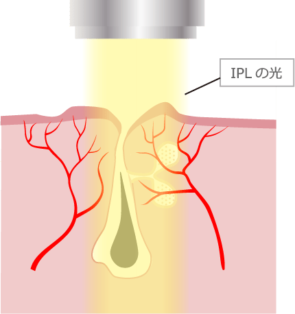 ニキビ跡の赤みとIPL治療