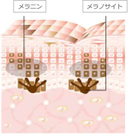 ニキビ跡の色素沈着とIPL治療