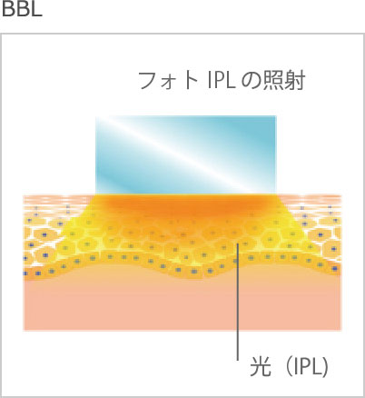 IPLの特徴